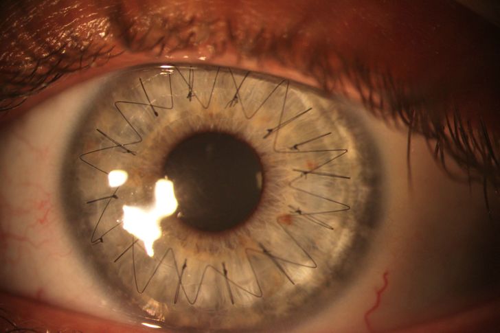 “My girlfriend recently got a cornea transplant. Here is a high res image of the stitches in her eye.”