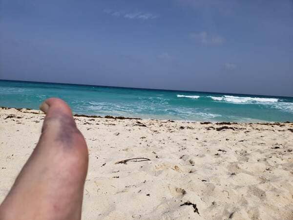 Broke my foot in Cancun…first day of my honeymoon.