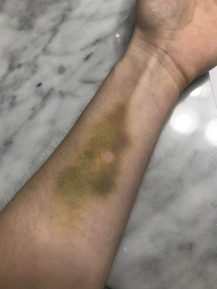 “A mosquito bit me on my bruise, leaving a perfect little circle in the middle.”