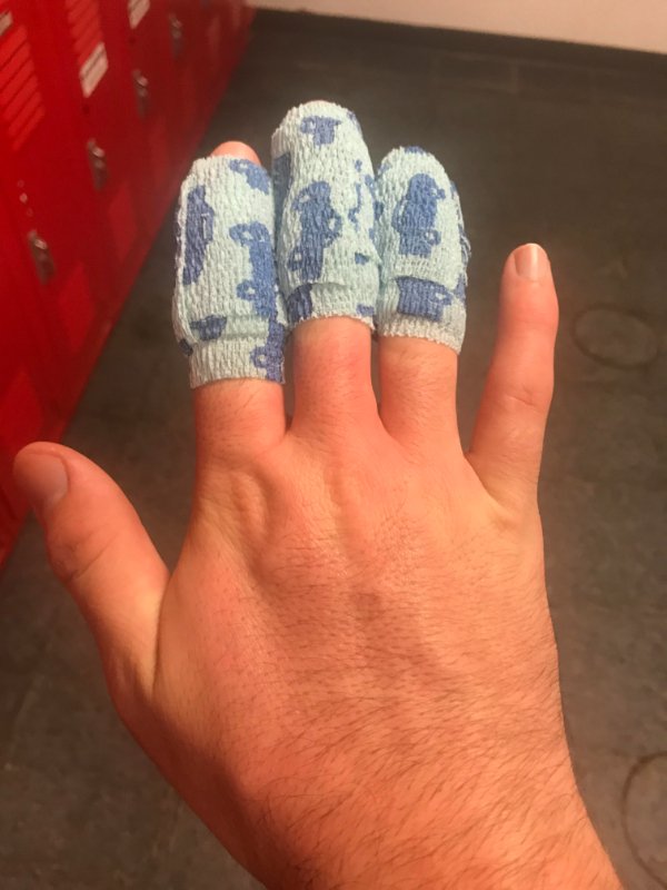“Gave myself 2nd degree burns on my fingers with a steam cooker at my job. Hurts like hell.”