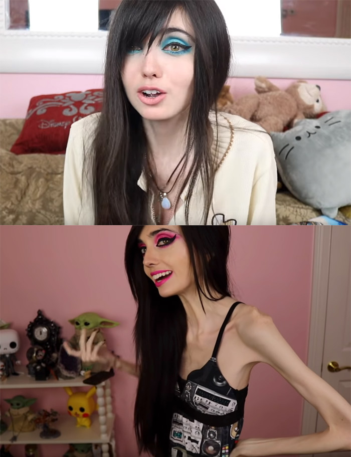 YouTuber Eugenia Cooney post-rehab in July 2019 compared to a week or so ago. She suffers from anorexia nervosa.