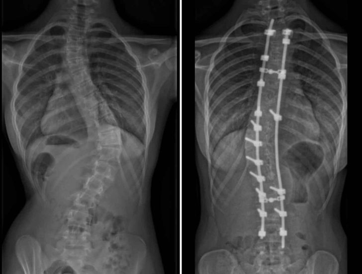 “6 years ago, I had surgery to straighten up my spine. This is the before and after result.”