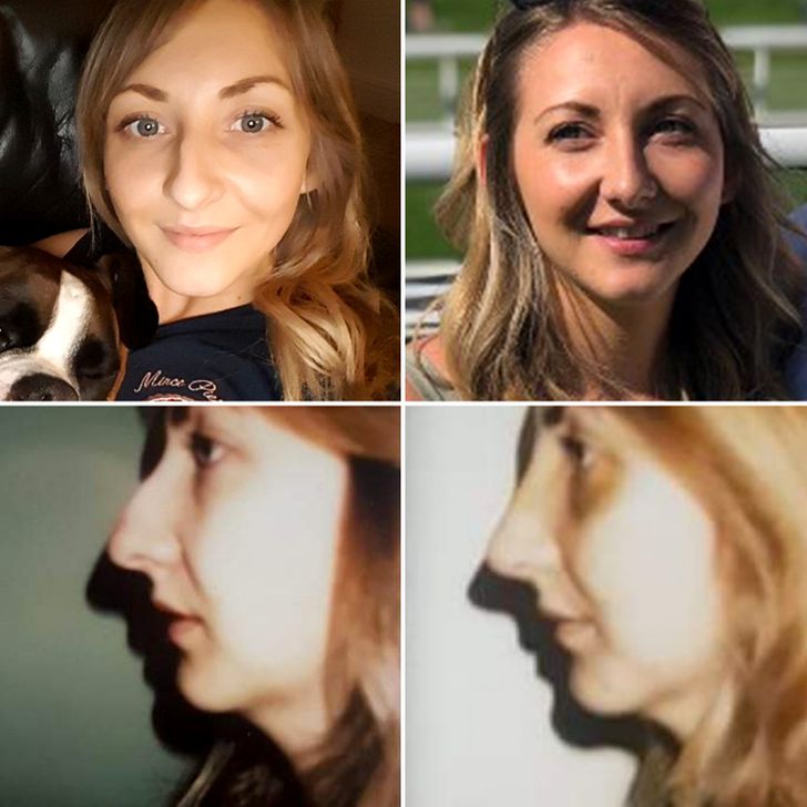 “Before pics on the left — had my nose done after hating it for 12+ years. Best decision I ever made.”