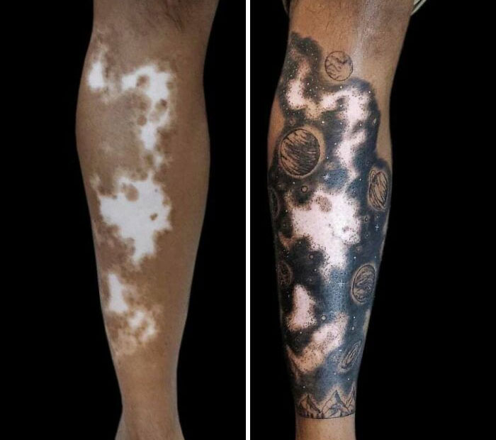 Turning Vitiligo Into An Art