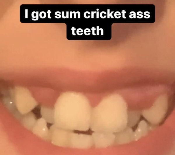 tooth - I got sum cricket ass teeth