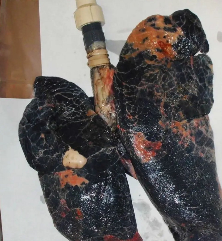 Charcoaled lungs of a heavy smoker
