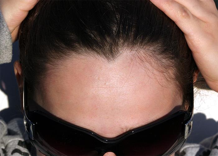 33% of the population has a widow's peak