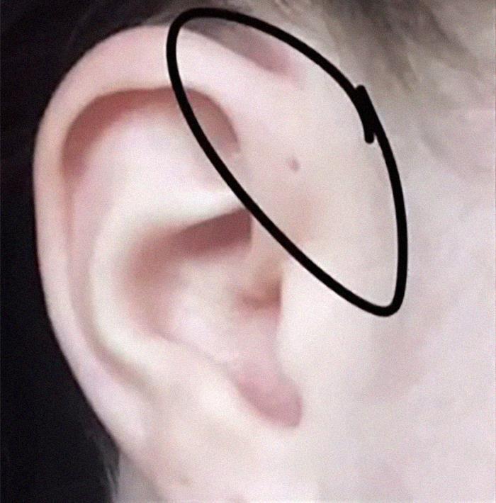 1% of people have a tiny hole above their ear.