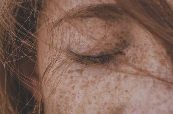 Freckles, 5% of the population.