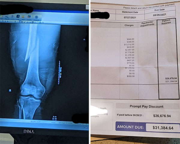 Before and after of my uninsured femur break.