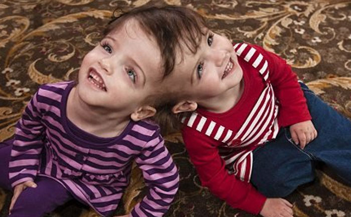 "These conjoined twin sisters actually share a brain, but not only that, they can hear each other's thoughts and they can see out of each other's eyes."