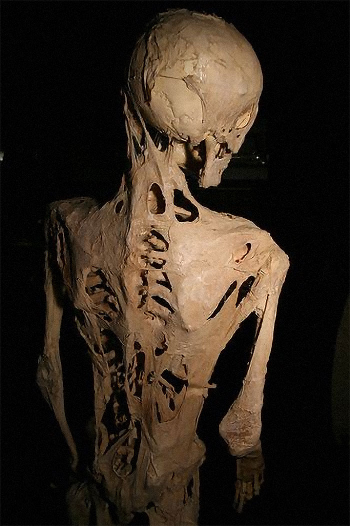 There is a genetic disease called fibrodisplaysia ossificans progresiva. When tissue is damaged, it is replaced with bone.

Growths form underneath their skin and their joints lock solid So over time those affected slowly become encased in a prison of bone just beneath their own skin.

They usually have to choose between sitting or standing up for the rest of their life. By the end of their life they have to drink every meal through a straw and can barely move