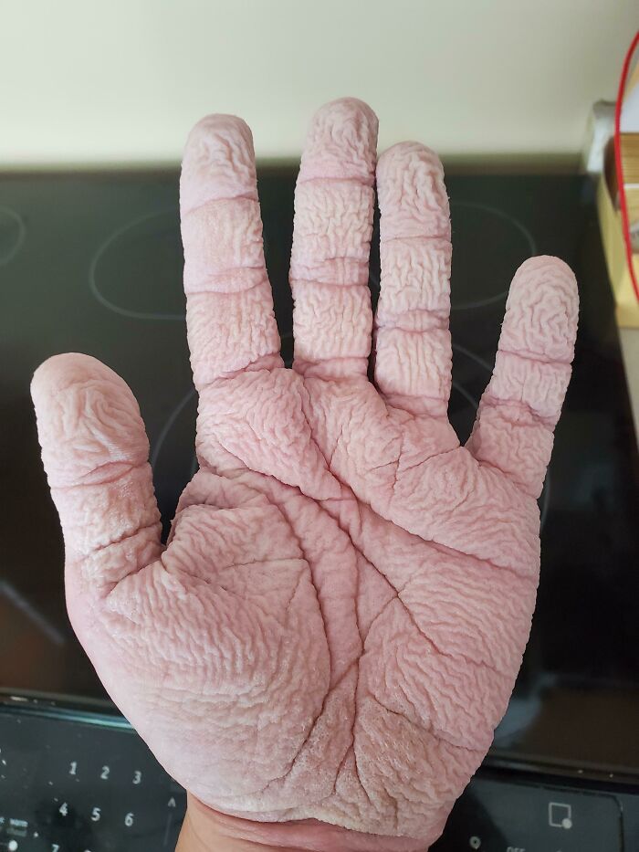 My Hands After Washing The Dishes For 20 Minutes