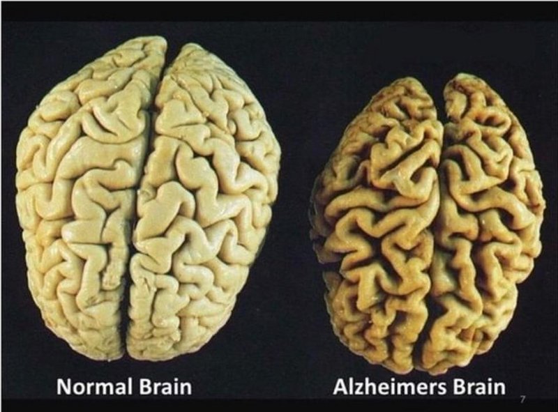 Normal brain vs alzheimers brain