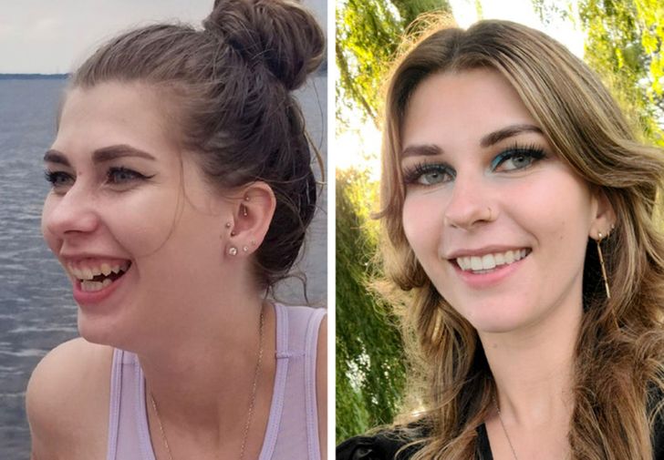 “My progress: I had braces and double jaw surgery to fix my teeth and skeletal issues.”