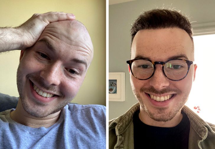 “6 months after my hair transplant”