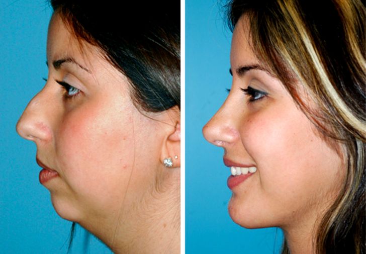 “I got a chin implant and a rhinoplasty. It was worth it!”