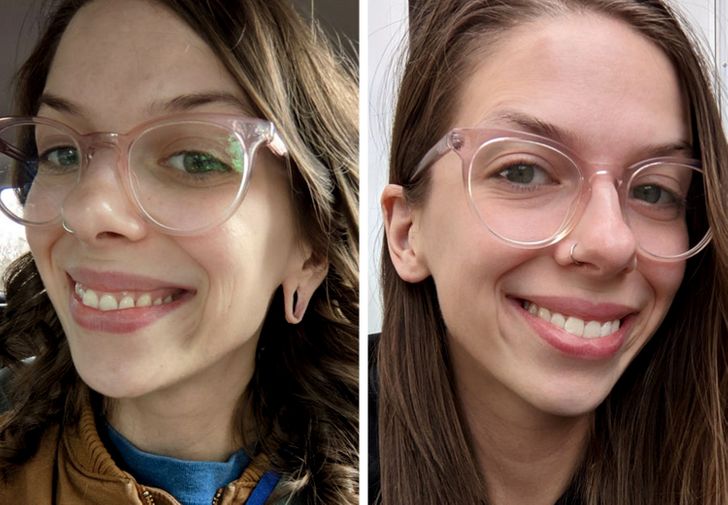 “After my earlobe reconstruction surgery, I love the way I look.”