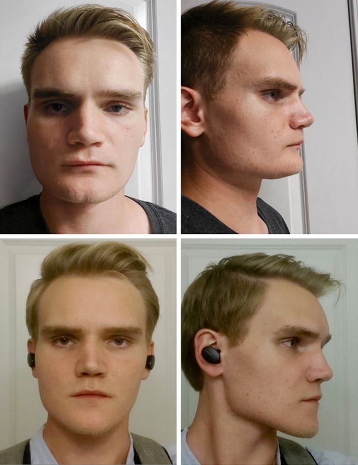 “My double jaw surgery was necessary, and the aesthetics were just a huge bonus!”