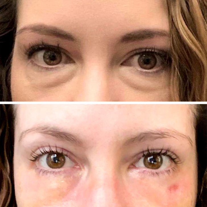 “7 days after my lower blepharoplasty. There’s still some swelling but I’m so happy with my results already.”