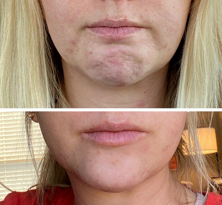 “10 units of Botox completely fixed the dimpling in my chin.”