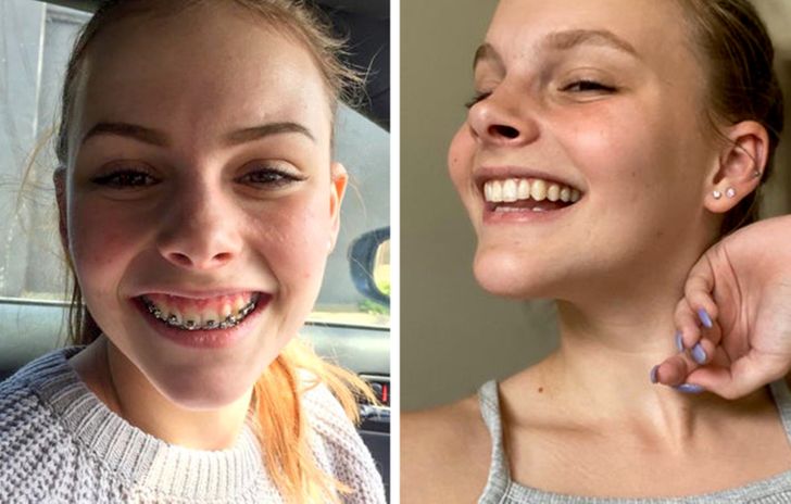 “Braces, double jaw surgery, bone grafting, a sinus lift, and dental implants. We’re finally done!”