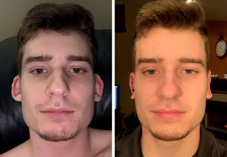 Otoplasty — before and 1 day post-op