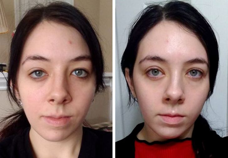 2 months post-op blepharoplasty and lateral canthopexy