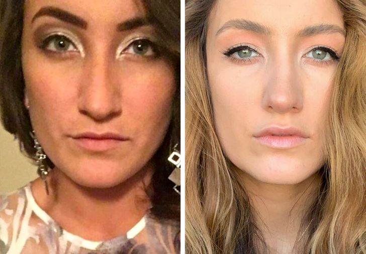 Before and a little over a year after rhinoplasty