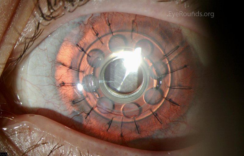 Artificial cornea implanted in a patient’s eye
