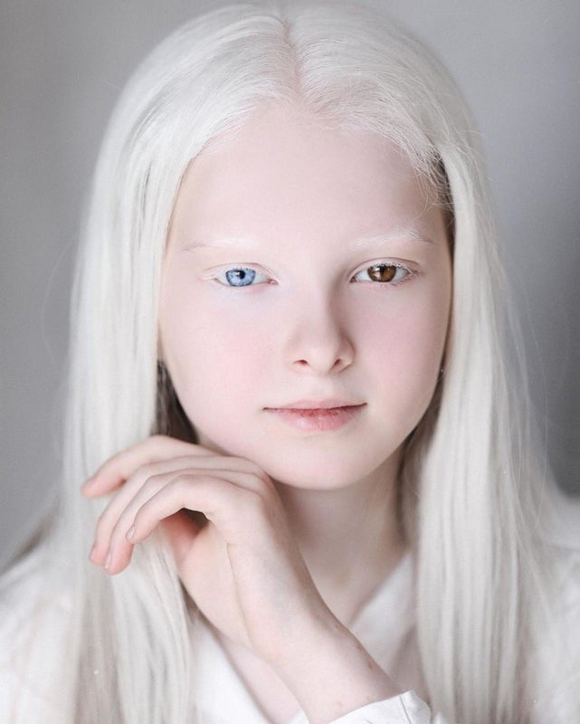 A girl with both albinism and heterochromia