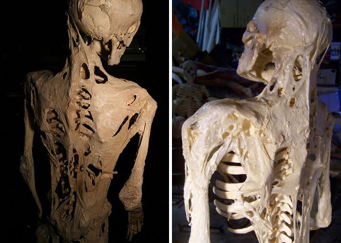 There is a (genetic) disease called FOP where your muscles and tissue turn to bone. Often called "human statue disease"

Eventually people may have to decide whether they want to become "frozen" in a sitting or flat/standing position.