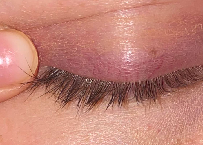 There are Demodex mites crawling on your eyelashes right now, and there's NOTHING YOU CAN DO ABOUT IT.