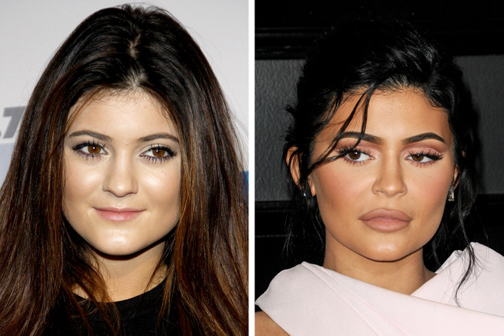 Celebrities Who Regret Plastic Surgery - Kylie Jenner