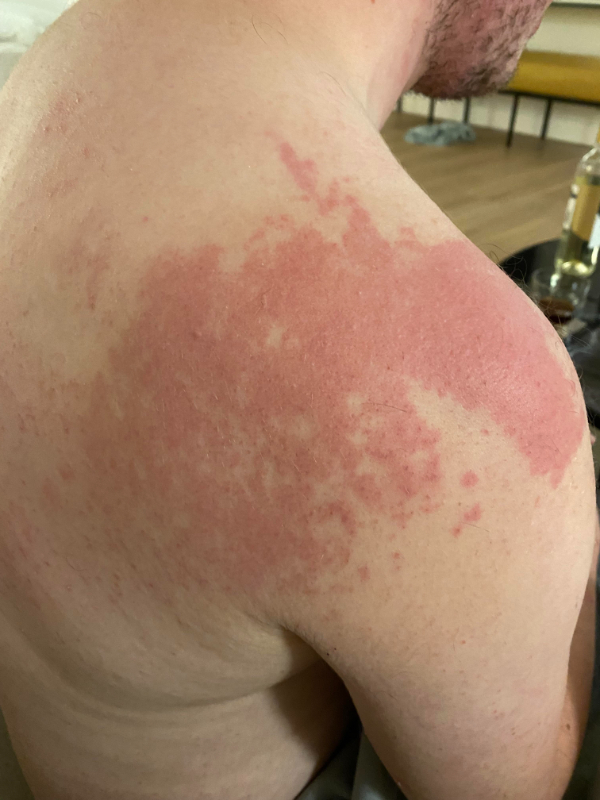 “Sudden red rash after drinking cheap alcohol.”