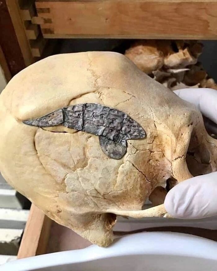 pics from history - peruvian skull metal implant - K