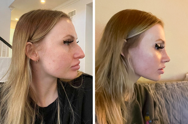 “Rhinoplasty before/after, 10 days post-op!”