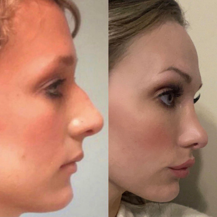 “I’m close to the 4-year anniversary of my rhinoplasty. One of the best decisions I’ve ever made.”