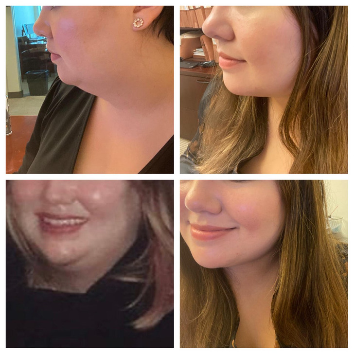 “This is 2 months post-op (41F) for chin/neck lipo”