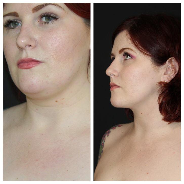 “Chin lipo update: almost 4 months post-op. Best decision ever. I don’t recognize that other person anymore.”