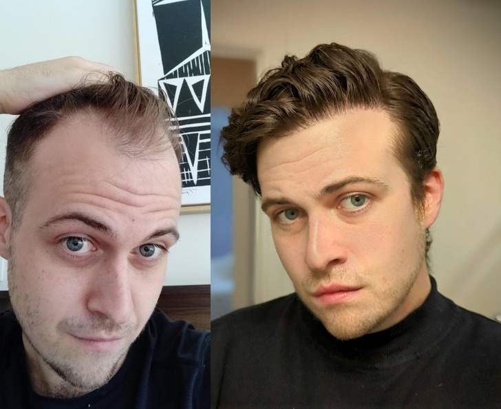 “One year after my hair transplant!”