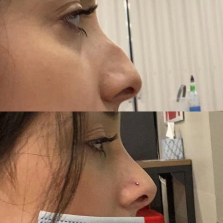 “Almost 8 months post-op of my septorhinoplasty”