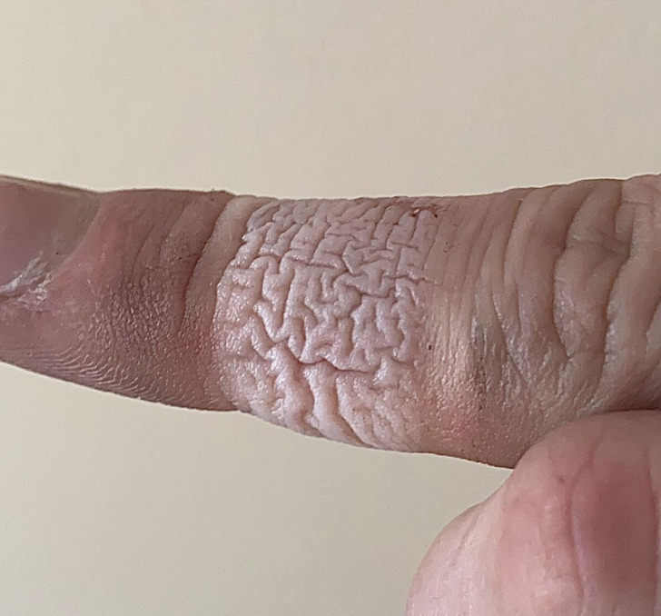 “These wrinkles on my finger after I removed a Band-Aid”