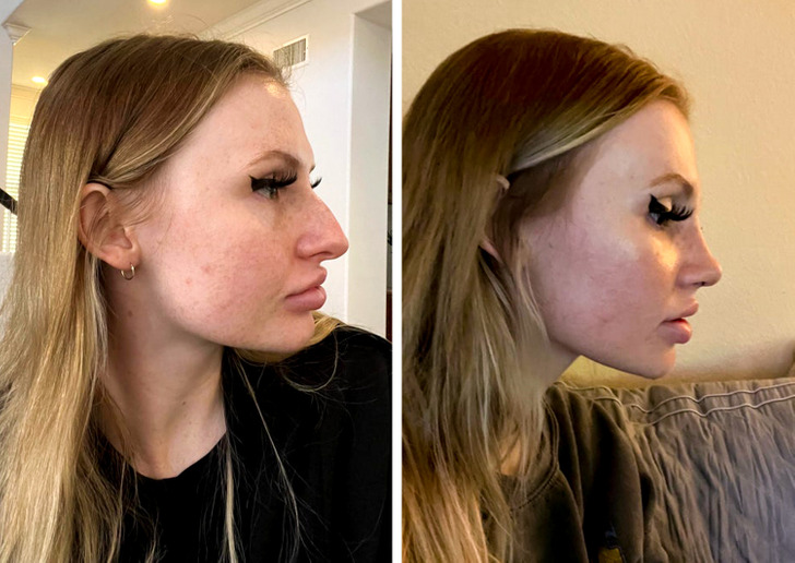 “Rhinoplasty before/after, 10 days post-op! My nose is straight now, it’s not pointy and not leaning anywhere.”