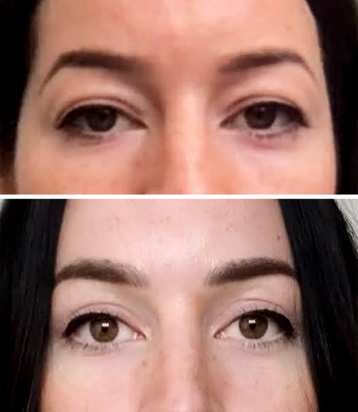 “Upper blepharoplasty ($2.5K) and microblading ($800)”