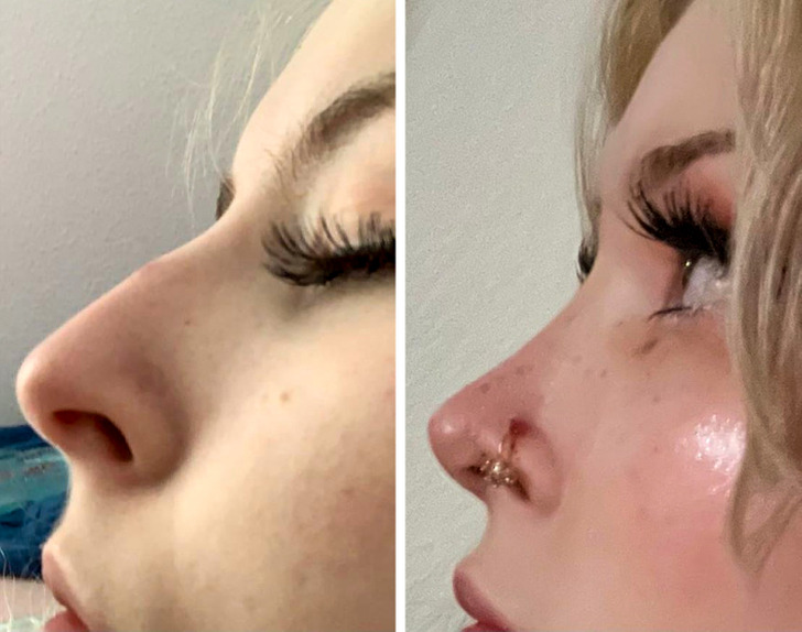 “4 months post-op rhinoplasty”