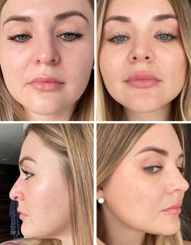 “6-month update after septorhinoplasty. My nose was leaning to the right so hard that I noticed an improvement right after the surgery.”