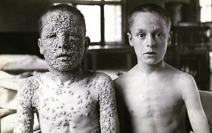 fascinating photos form history  - Unvaccinated And Vaccinated Boys With Small Pox