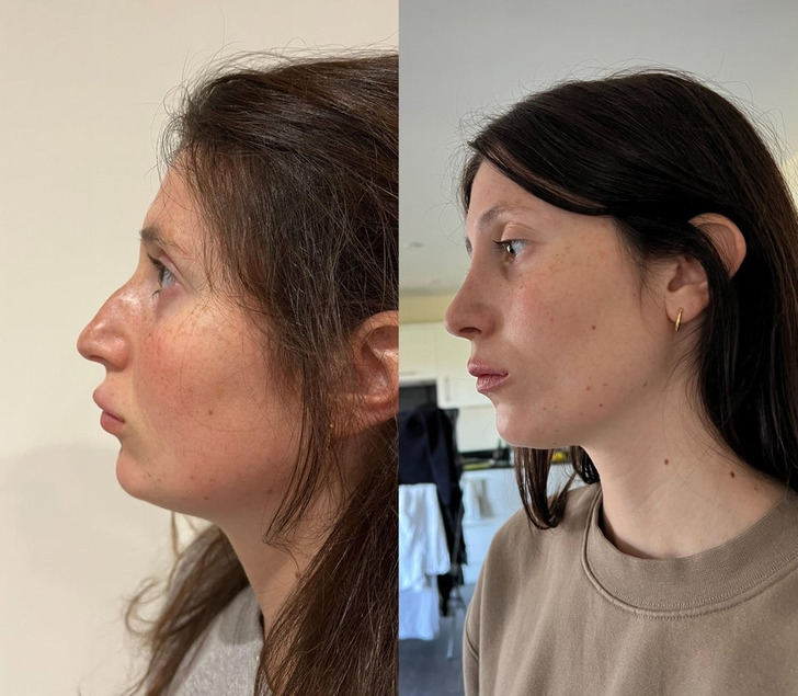 “Septorhinoplasty before and after, 3.5 weeks post-op update”