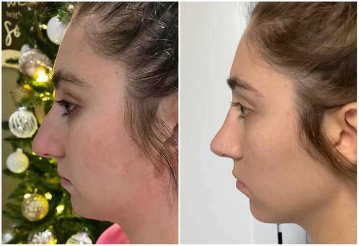 “Rhinoplasty — 3 months without follow-up concerns”